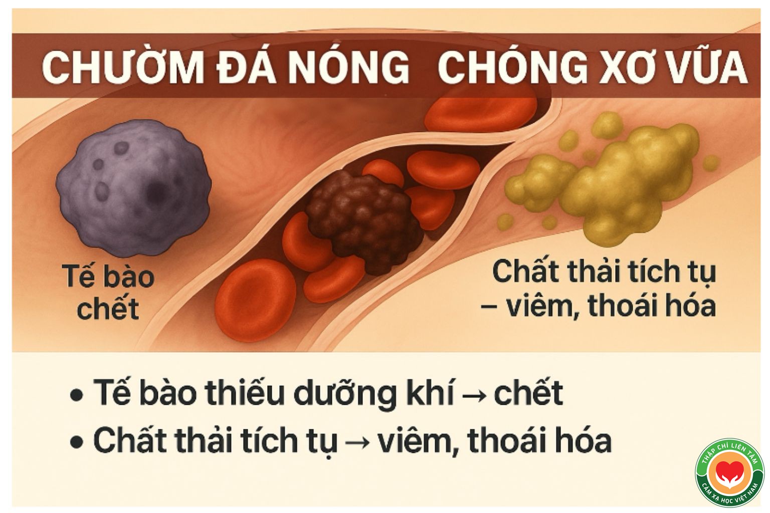 Cặp Đá Diệu Kỳ: Câu Chuyện Thầy Dư Quang Châu Chữa Lành Xơ Vữa Động Mạch (bài 4)