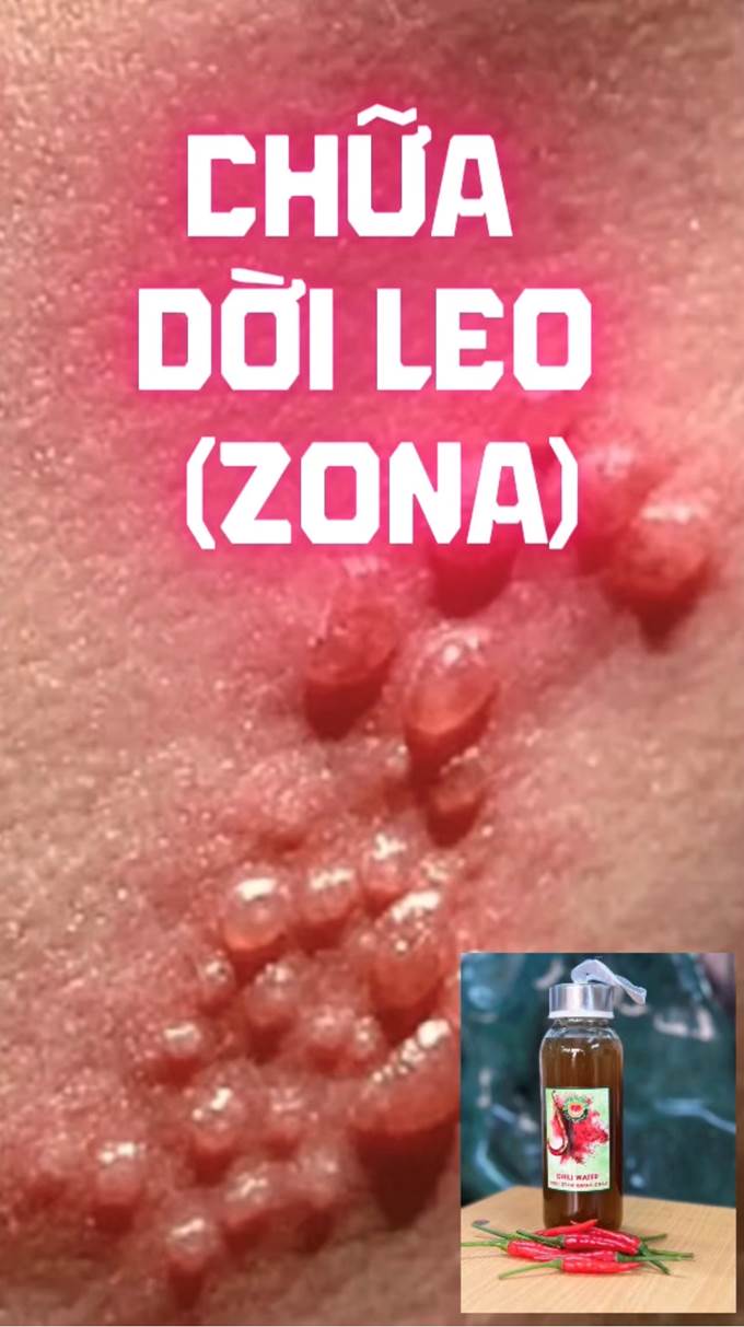 Câu Chuyện Chữa Dời Leo (Zona) Bằng Rượu Ớt (Bài 47)