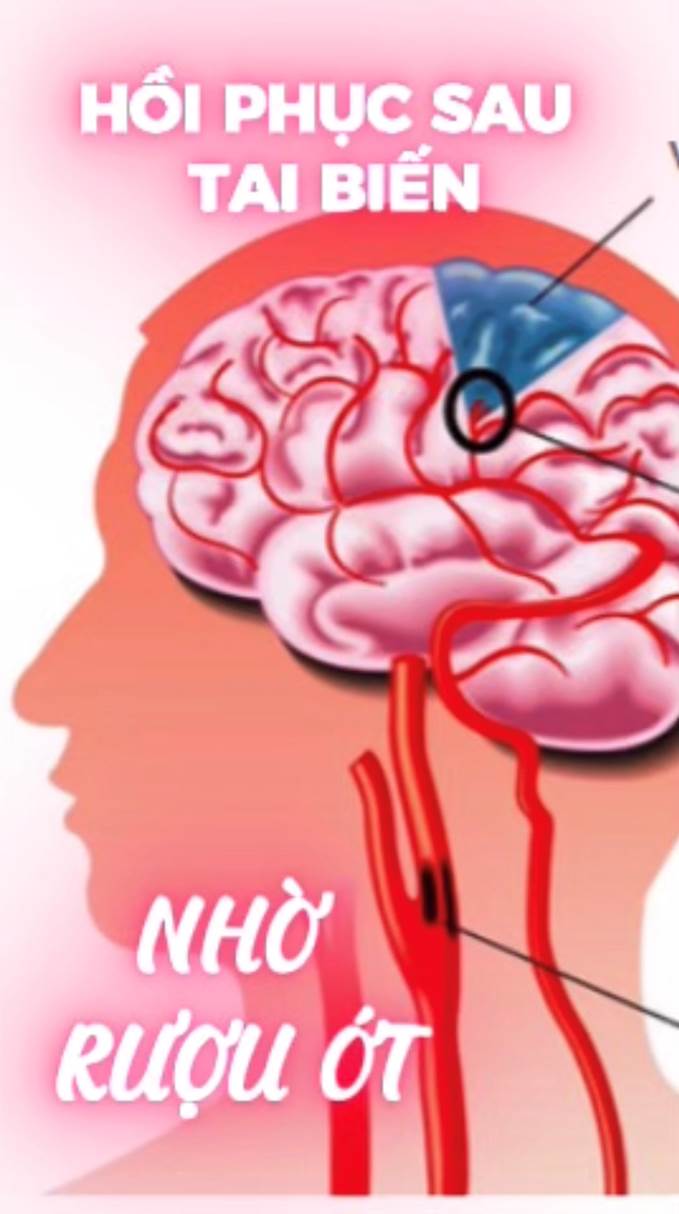 Hành Trình Hồi Phục Sau Tai Biến Nhờ Rượu Ớt (Bài 50)